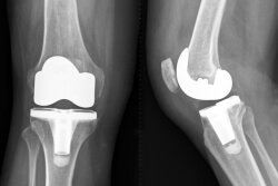 knee replacement x-ray image